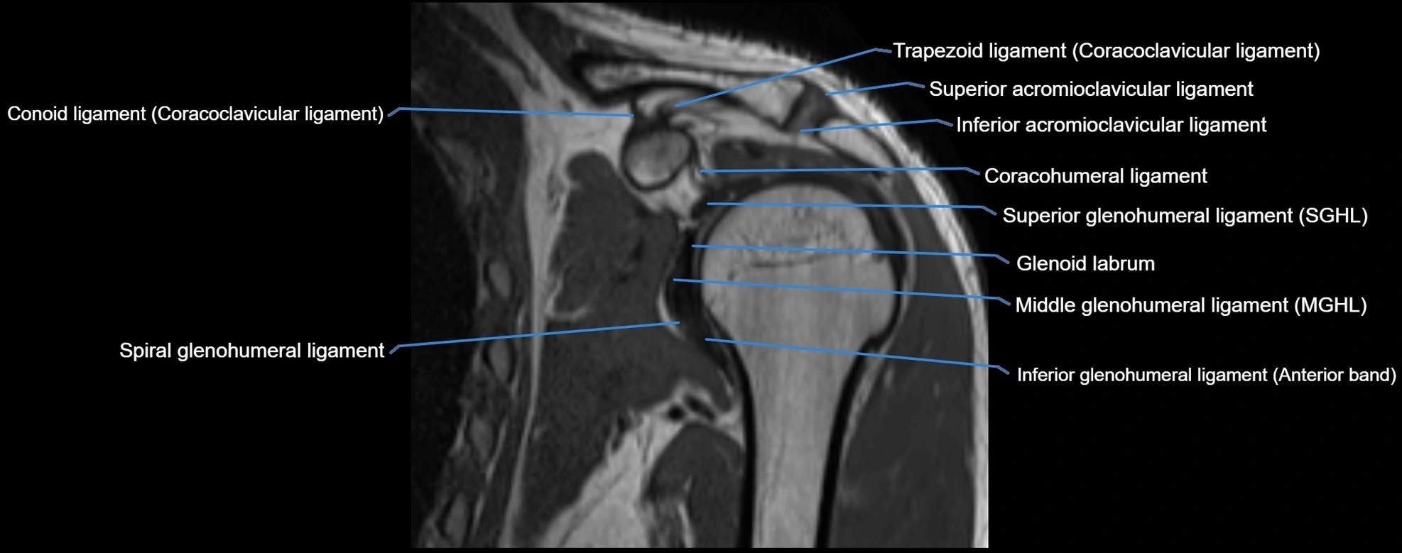 shoulder ligments coronal  cross sectional anatomy 3T MRI AI enhanced radiology image -img-00001-00021.webp